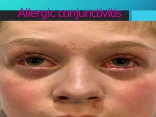 Allergic conjunctivitis
 