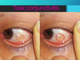 Toxicconjunctivitis
 