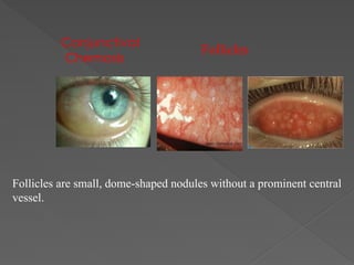 Conjunctival
Chemosis
Follicles
Follicles are small, dome-shaped nodules without a prominent central
vessel.
 