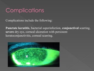 Complications
Complications include the following:
Punctate keratitis, bacterial superinfection, conjunctival scarring,
severe dry eye, corneal ulceration with persistent
keratoconjunctivitis, corneal scarring.
 