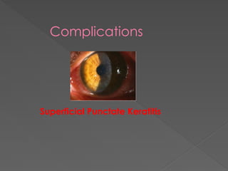 Complications
Superficial Punctate Keratitis
 