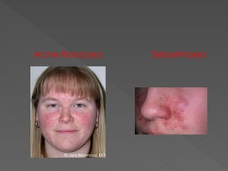Acne Rosacea Seborrhoea
 