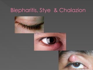 Blepharitis, Stye & Chalazion
 