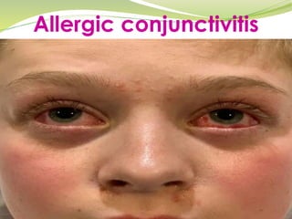 Allergic conjunctivitis
 