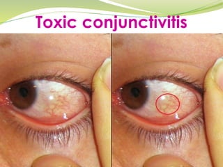 Toxic conjunctivitis
 