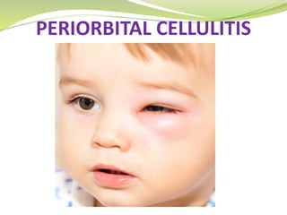 PERIORBITAL CELLULITIS
 