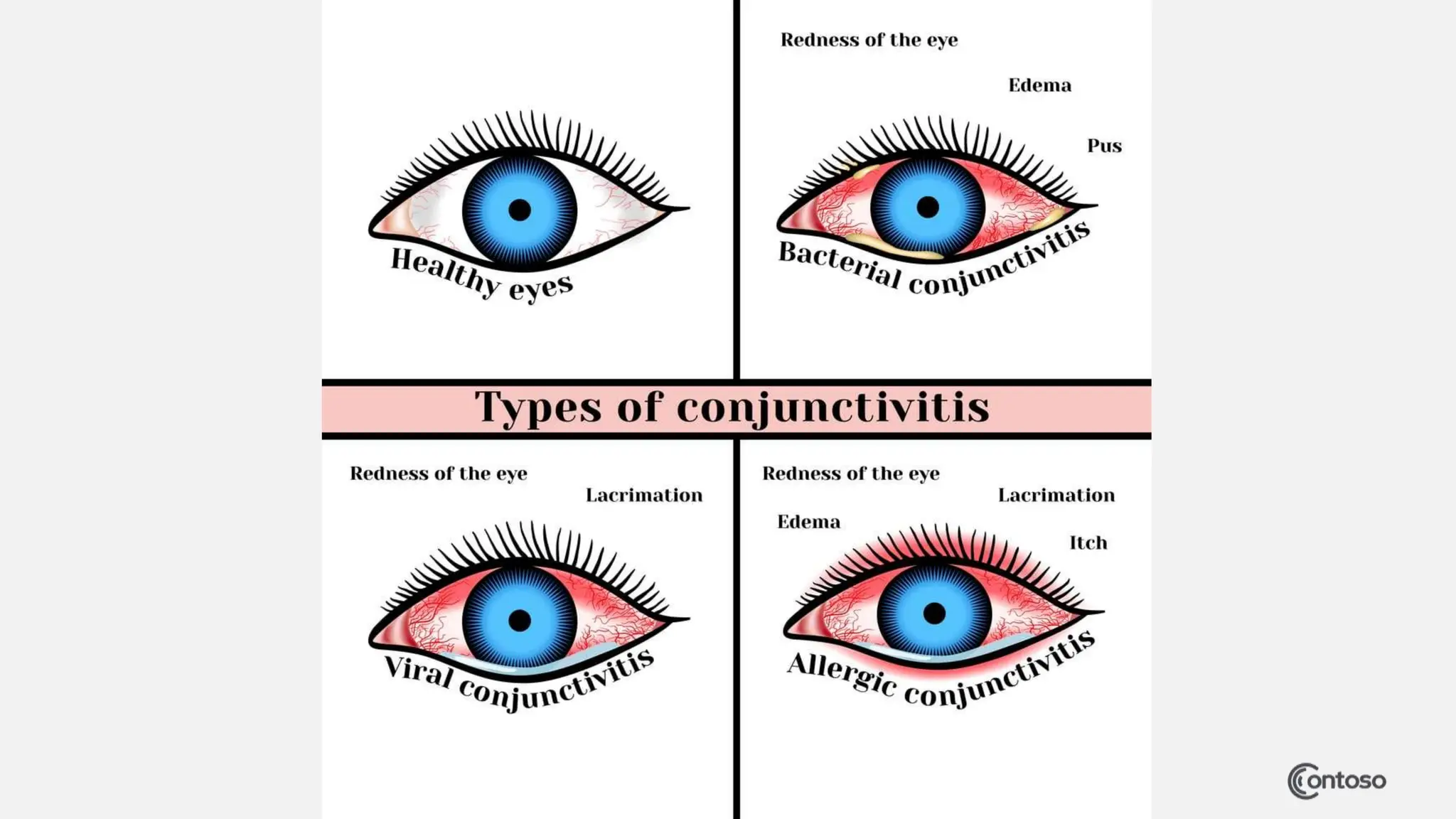 Conjunctivitis Its Types Clinical Manifestation And Nursing conjunctivitis-its-types-clinical-manifestation-and-nursing