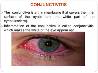 Conjunctivitis | PPTX