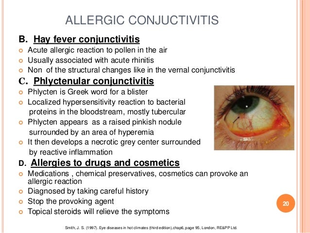 Conjunctivitis by Muhammad ibrahim