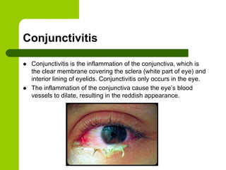 Conjunctivitis

   Conjunctivitis is the inflammation of the conjunctiva, which is
    the clear membrane covering the sclera (white part of eye) and
    interior lining of eyelids. Conjunctivitis only occurs in the eye.
   The inflammation of the conjunctiva cause the eye’s blood
    vessels to dilate, resulting in the reddish appearance.
 