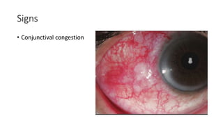 Signs
• Conjunctival congestion
 