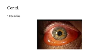 Contd.
• Chemosis
 