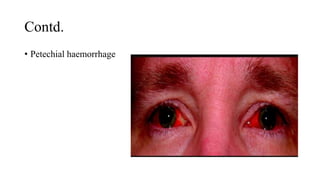 Contd.
• Petechial haemorrhage
 
