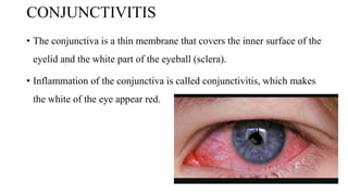 CONJUNCTIVITIS
• The conjunctiva is a thin membrane that covers the inner surface of the
eyelid and the white part of the eyeball (sclera).
• Inflammation of the conjunctiva is called conjunctivitis, which makes
the white of the eye appear red.
 