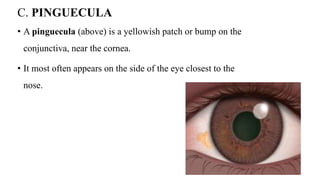 C. PINGUECULA
• A pinguecula (above) is a yellowish patch or bump on the
conjunctiva, near the cornea.
• It most often appears on the side of the eye closest to the
nose.
 