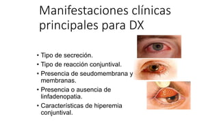 Manifestaciones clínicas
principales para DX
• Tipo de secreción.
• Tipo de reacción conjuntival.
• Presencia de seudomembrana y
membranas.
• Presencia o ausencia de
linfadenopatia.
• Características de hiperemia
conjuntival.
 