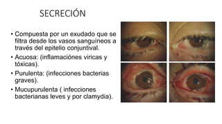 SECRECIÓN
• Compuesta por un exudado que se
filtra desde los vasos sanguíneos a
través del epitelio conjuntival.
• Acuosa: (inflamaciónes viricas y
tóxicas).
• Purulenta: (infecciones bacterias
graves).
• Mucupurulenta ( infecciones
bacterianas leves y por clamydia).
 