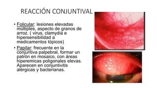 REACCIÓN CONJUNTIVAL
• Folicular: lesiones elevadas
múltiples, aspecto de granos de
arroz. ( virus, clamydia e
hipersensibilidad a
medicamentos tópicos)
• Papilar: frecuente en la
conjuntiva palpebral, formar un
patrón en mosaico, con áreas
hiperemicas poligonales elevas.
Aparecen en conjuntivitis
alérgicas y bacterianas.
 