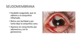 SEUDOMEMBRANA
• Exudado coagulado, que se
adhiere a la conjuntiva
inflamada.
• Retira con facilidad y por
tanto deja la conjuntiva sana.
• Aparece en conjuntivitis por
adenovirus y en la
gonococica.
 