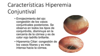 Características Hiperemia
Conjuntival
• Enrojecimiento del ojo:
congestión de los vasos
conjuntivales posteriores. Se
observa en todos los tipos de
conjuntivitis, disminuye en la
cercanía de la córnea y es de
color rojo ladrillo brillante.
• Hiperemia Ciliar: congestión de
los vasos filiares y es más
intensa hacia la córnea.
 