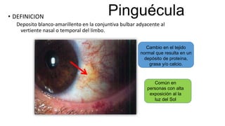 • DEFINICION
Deposito blanco-amarillento en la conjuntiva bulbar adyacente al
vertiente nasal o temporal del limbo.
Cambio en el tejido
normal que resulta en un
depósito de proteína,
grasa y/o calcio.
Común en
personas con alta
exposición al la
luz del Sol
Pinguécula
 
