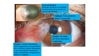 Cabeza: Área grisácea,
plana y avascular
Cuello: se hallan
los finos neovasos
incipientes
Cuerpo: Contiene fibroblastos,
vasos sanguíneos y se acompaña
de un infiltrado celular inflamatorio
y una acumulación anormal de
matriz extracelular compuesta de
elastina y colágena
Linea de Stocker.
Deposito de hierro en el epitelio
corneal antes de la cabeza de
avance del pterigión
 