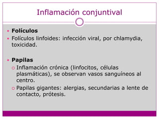 Inflamación conjuntivalFolículosFolículoslinfoides: infección viral, porchlamydia, toxicidad.PapilasInflamacióncrónica (linfocitos, célulasplasmáticas), se observanvasossanguíneos al centro.Papilasgigantes: alergias, secundarias a lente de contacto, prótesis. 