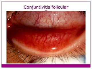 Conjuntivitis folicular
