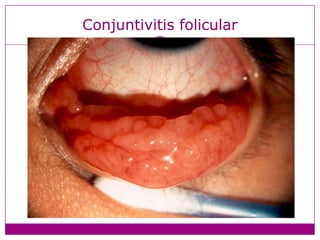Conjuntivitis folicular