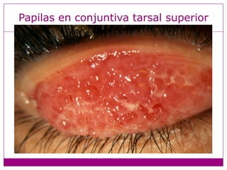 Papilas en conjuntiva tarsal superior