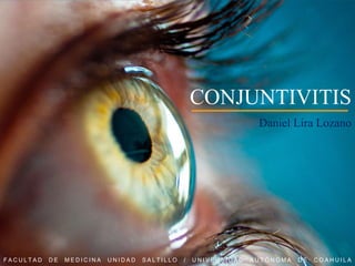 CONJUNTIVITIS
Daniel Lira Lozano
FACULTAD DE MEDICINA UNIDAD SALTILLO / UNIVERSIDAD AUTÓNOMA DE COAHUILA
 