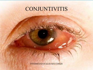CONJUNTIVITIS BACTERIANA
AGUDA
S. pneumoniae
S. aureus
H. influenzae
M. catarrhalis
N. gonorrhoeae
N. meningitidis
• Es de...