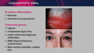 CONJUNTIVITE VIRAL
Al examen oftalmologico:
੦ folículos
੦ secreción mucopurulenta
Tratamiento general:
੦ higiene
੦ compressas (água fria)
੦ colírio lubricante (lagrimas
artificiales)
੦ AINE (tópico/sistemico:
controversia)
੦ Baja medica (estudios, trabajo
etc.)
 