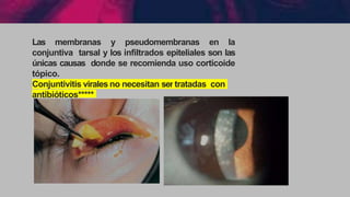 Las membranas y pseudomembranas en la
conjuntiva tarsal y los infiltrados epiteliales son las
únicas causas donde se recomienda uso corticoide
tópico.
Conjuntivitis virales no necesitan sertratadas con
antibióticos*****
 