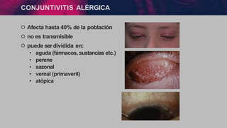 CONJUNTIVITIS ALÉRGICA
੦ Afecta hasta 40% de la población
੦ no es transmisible
੦ puede serdividida en:
• aguda (fármacos, sustancias etc.)
• perene
• sazonal
• vernal (primaveril)
• atópica
 