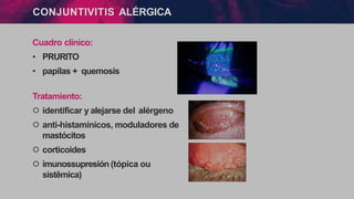 CONJUNTIVITIS ALÉRGICA
Cuadro clínico:
• PRURITO
• papilas + quemosis
Tratamiento:
੦ identificar y alejarse del alérgeno
੦ anti-histamínicos, moduladores de
mastócitos
੦ corticoides
੦ imunossupresión(tópica ou
sistêmica)
 