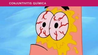 CONJUNTIVITIS QUÍMICA
 