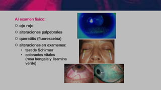 Al examen fisico:
੦ ojo rojo
੦ alteraciones palpebrales
੦ queratitis (fluoresceína)
੦ alteraciones en examenes:
• test de Schirmer
• colorantes vitales
(rosa bengala y lisamina
verde)
 