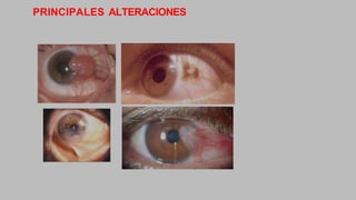 PRINCIPALES ALTERACIONES
 