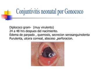Conjuntivitis neonatal por Gonococo Diplococo gram-  (muy virulento) 24 a 48 hrs despues del nacimiento. Edema de parpado , quemosis, secrecion serosanguinolenta Purulenta, ulcera corneal, absceso ,perforacion. 