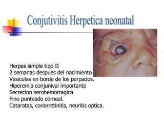 Conjutivitis Herpetica neonatal Herpes simple tipo II 2 semanas despues del nacimiento Vesiculas en borde de los parpados. Hiperemia conjunival importante Secrecion serohemorragica Fino punteado corneal. Cataratas, coriorretinitis, neuritis optica. 