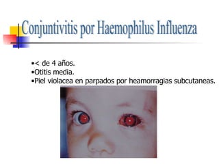 Conjuntivitis por Haemophilus Influenza < de 4 años. Otitis media. Piel violacea en parpados por heamorragias subcutaneas. 