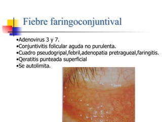 Fiebre faringoconjuntival Adenovirus 3 y 7. Conjuntivitis folicular aguda no purulenta. Cuadro pseudogripal,febril,adenopatia pretragueal,faringitis. Qeratitis punteada superficial Se autolimita. 