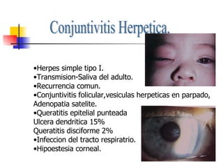 Conjuntivitis Herpetica. Herpes simple tipo I. Transmision-Saliva del adulto. Recurrencia comun. Conjuntivitis folicular,vesiculas herpeticas en parpado, Adenopatia satelite. Queratitis epitelial punteada Ulcera dendritica 15% Queratitis disciforme 2% Infeccion del tracto respiratrio. Hipoestesia corneal. 
