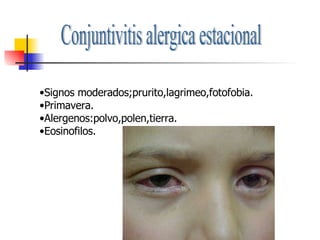 Conjuntivitis alergica estacional Signos moderados;prurito,lagrimeo,fotofobia. Primavera. Alergenos:polvo,polen,tierra. Eosinofilos. 