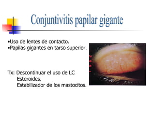 Conjuntivitis papilar gigante Uso de lentes de contacto. Papilas gigantes en tarso superior. Tx: Descontinuar el uso de LC Esteroides. Estabilizador de los mastocitos. 