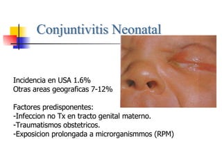 Conjuntivitis Neonatal Incidencia en USA 1.6% Otras areas geograficas 7-12% Factores predisponentes: -Infeccion no Tx en tracto genital materno. -Traumatismos obstetricos. -Exposicion prolongada a microrganismmos (RPM) 