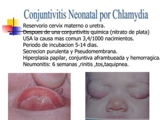 Conjuntivitis Neonatal por Chlamydia Reservorio cervix materno o uretra. Despues de una conjuntivitis quimica (nitrato de plata) USA la causa mas comun 3,4/1000 nacimientos. Periodo de incubacion 5-14 dias. Secrecion purulenta y Pseudomembrana. Hiperplasia papilar, conjuntiva aframbueada y hemorragica. Neumonitis: 6 semanas ,rinitis ,tos,taquipnea. 