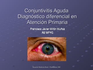 Conjuntivitis Aguda  Diagnóstico diferencial en Atención Primaria Francisco Javier Mirón Muñoz R2 MFYC Francisco Javier Mirón Muñoz R2 MFYC 