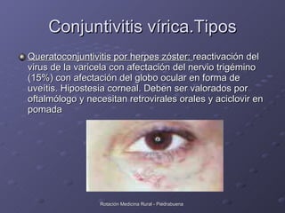 Conjuntivitis vírica.Tipos <ul><li>Queratoconjuntivitis por herpes zóster:  reactivación del virus de la varicela con afec...
